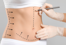 karın liposuction