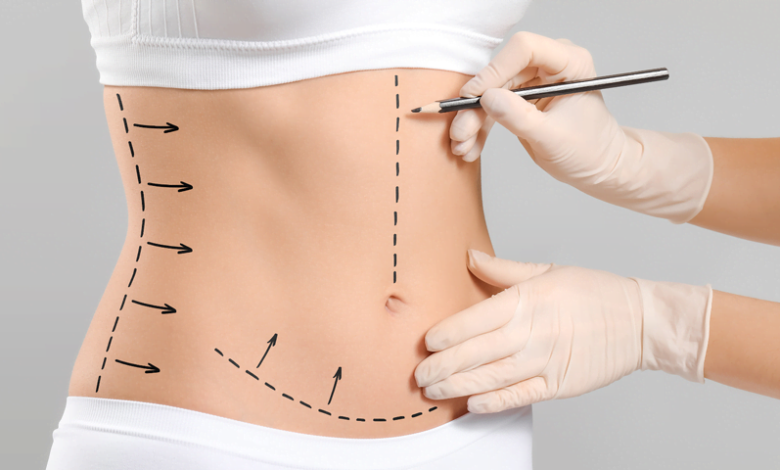 karın liposuction