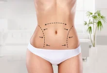 lazer liposuction