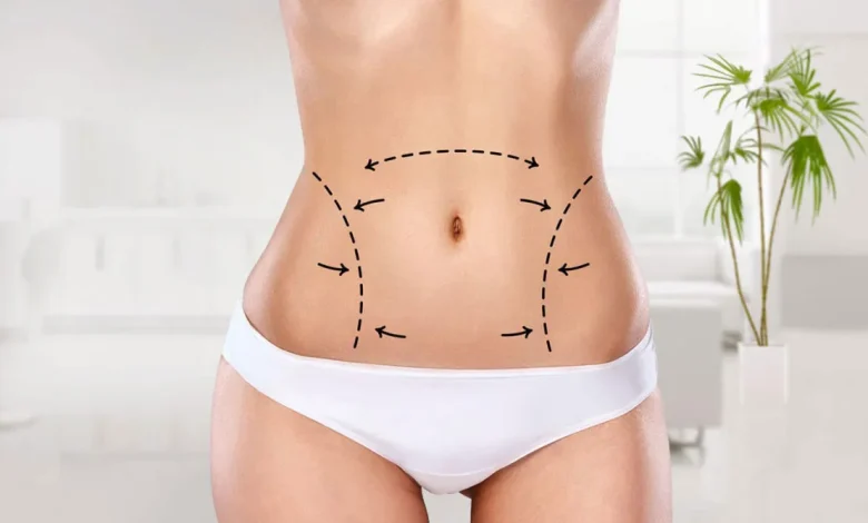 lazer liposuction